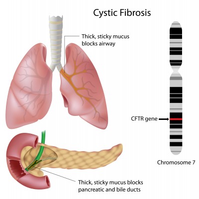 What treatments are used with cystic fibrosis?