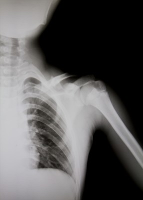 Shoulder X Ray