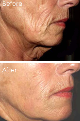 Sculptra Before And After Pictures Of A Woman's Face
