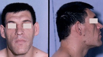 Acromegaly Facial features