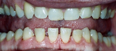 Acromegaly Teeth Gapping HGH overdose